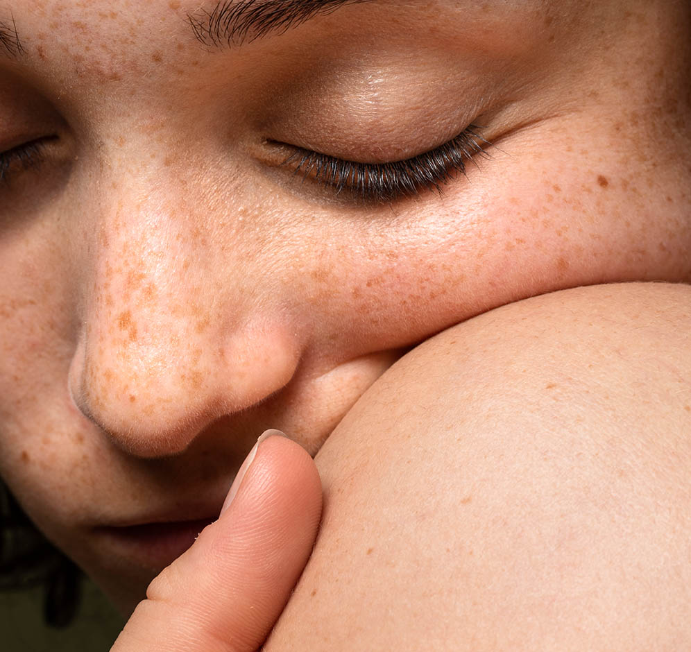 Cilt Lekelerinizden Sonbahar ve Kış Aylarında Kurtulabilirsiniz