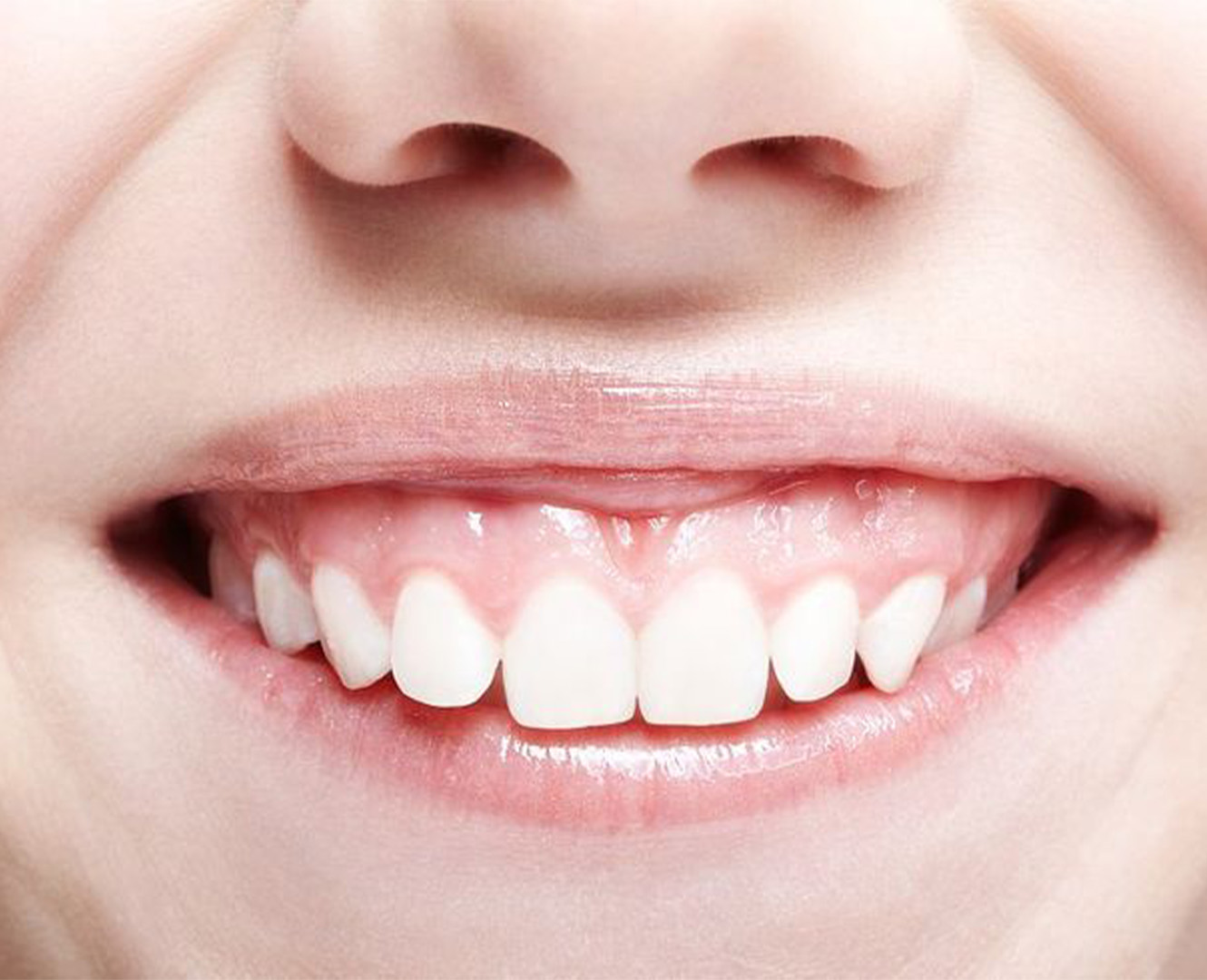 Gummy Smile Botox (Diş Eti Botoksu)