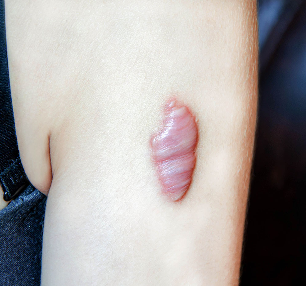 Keloid Nedir? Nedenleri ve Tedavisi