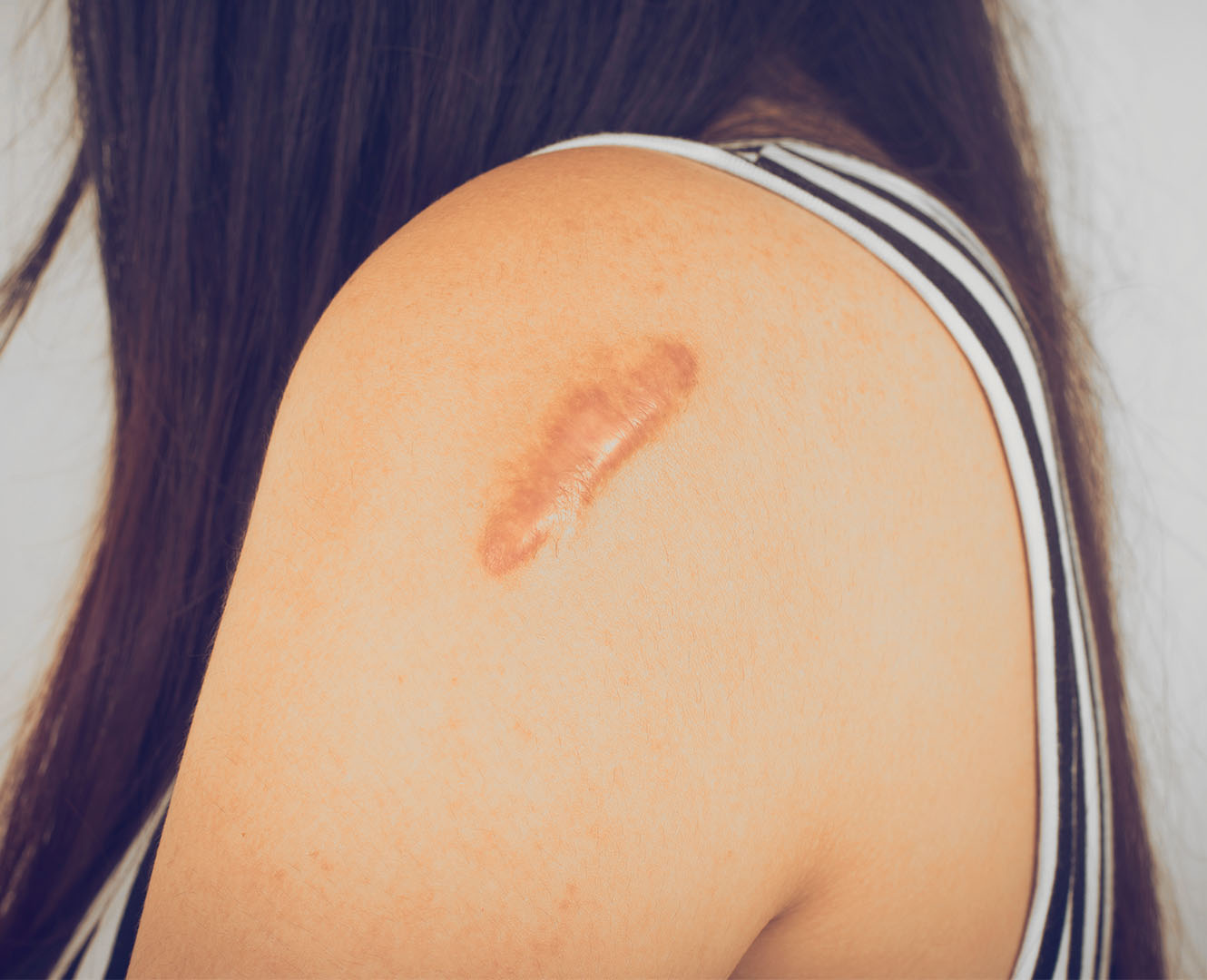 Keloid SKAR