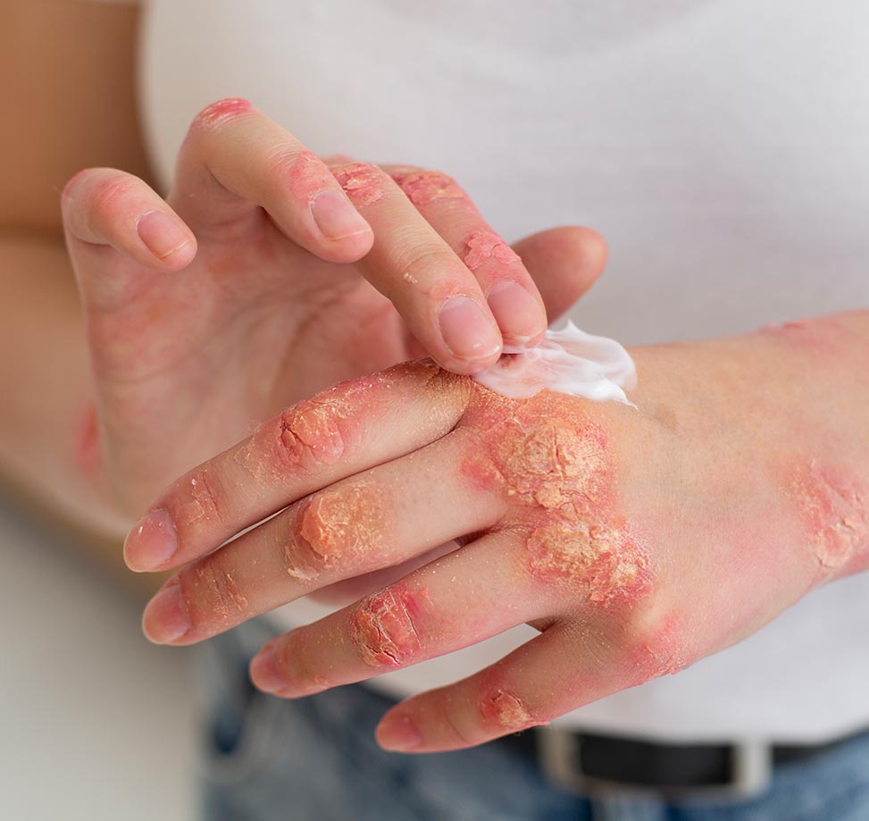 Mantar Hastalığı Hangi Dönemde Artar