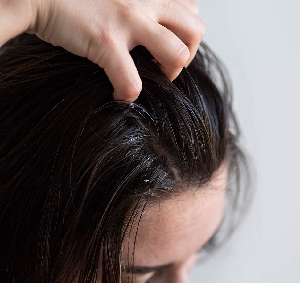 Saç Mantarı Belirtileri Nelerdir