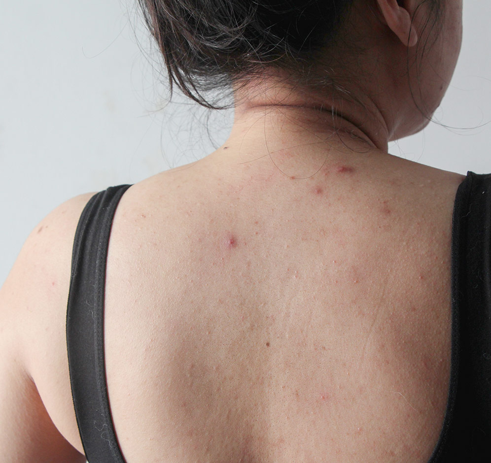 Sırt Sivilcesi Neden Olur? Nasıl İyileşir?