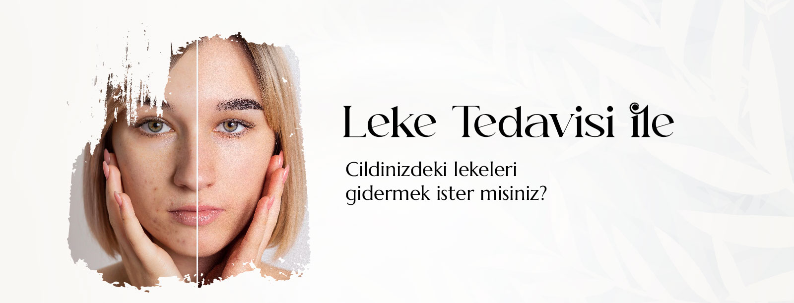Leke Tedavisi ile cildinizdeki lekeleri giderin
