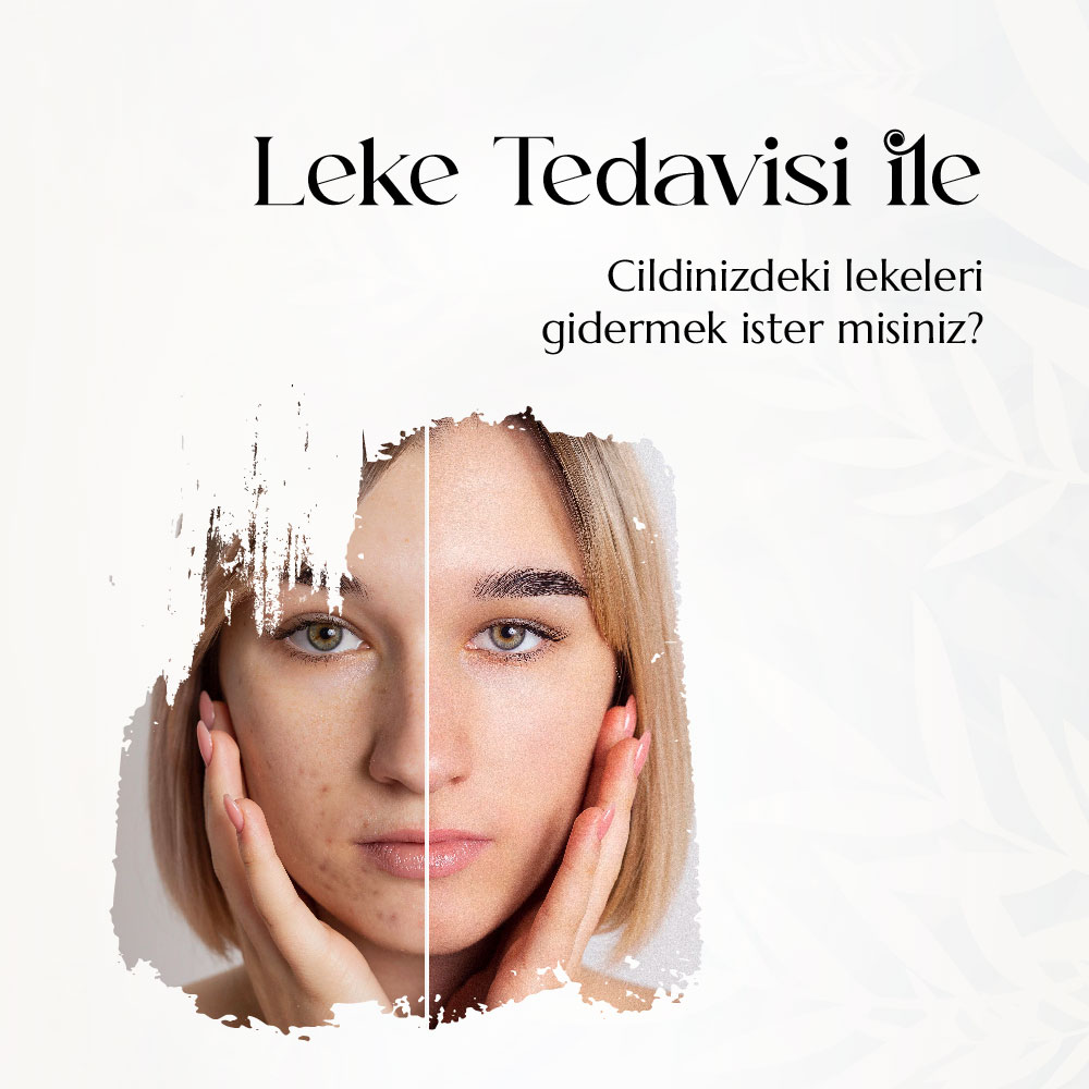 Leke Tedavisi ile cildinizdeki lekeleri giderin